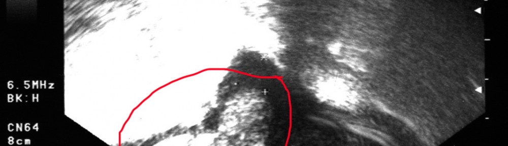 Ultraschall Bild meines Baby in der 11. Woche 11