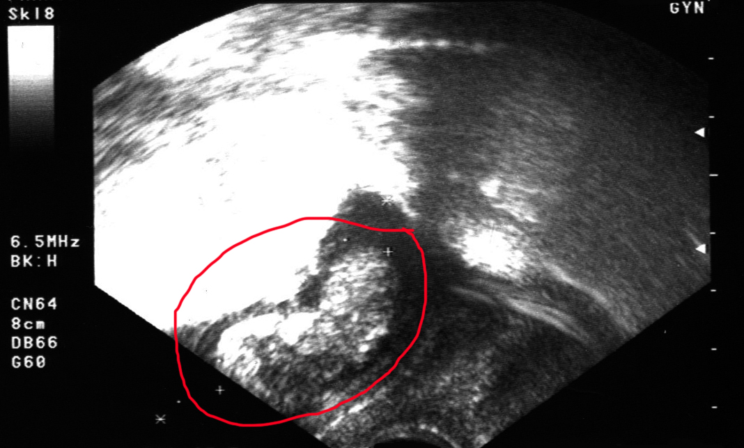 Ultraschall Bild meines Baby in der 11. Woche 11