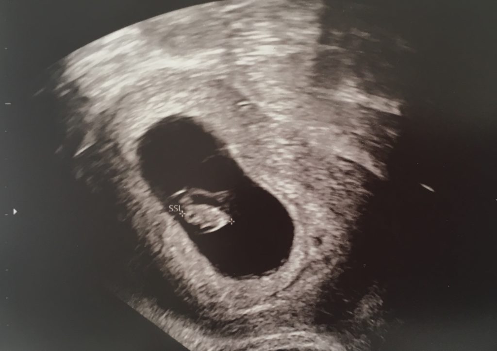 Da-bist-du - Das erste Ultraschall-Foto von unserem Baby